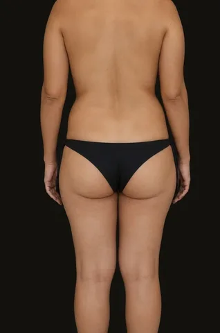 Antes de Lipoescultura + Gluteoplastia con Grasa, paciente del Dr. Edgar Achá Vargas