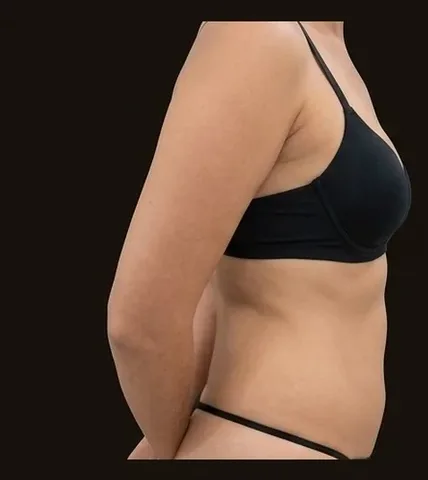 Antes de Lipoescultura + Mamoplastia de Aumento, paciente del Dr. Edgar Achá Vargas