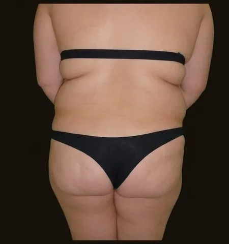 Antes de Lipoescultura + Gluteoplastia con Grasa, paciente del Dr. Edgar Achá Vargas