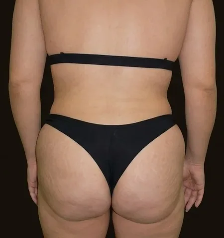 Después de Lipoescultura + Gluteoplastia con Grasa, paciente del Dr. Edgar Achá Vargas