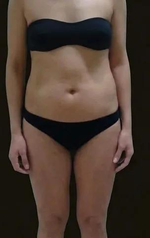 Antes de Lipoescultura + Mamoplastia de Aumento, paciente del Dr. Edgar Achá Vargas