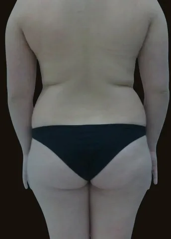 Antes de Lipoescultura, paciente del Dr. Edgar Achá Vargas