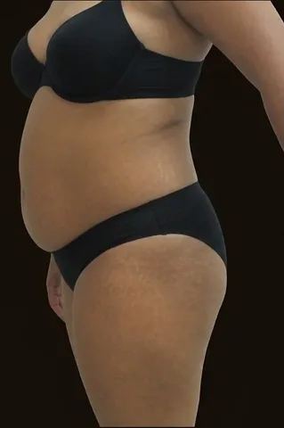 Antes de Lipoescultura + Abdominoplastia + Mastopexia, paciente del Dr. Edgar Achá Vargas