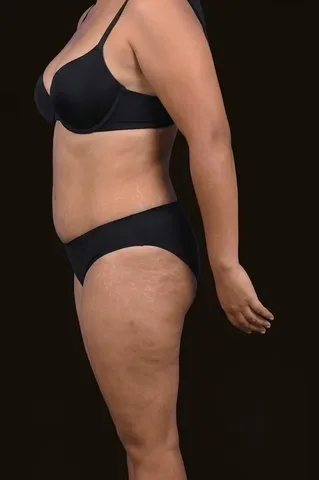 Después de Lipoescultura + Abdominoplastia + Mastopexia, paciente del Dr. Edgar Achá Vargas