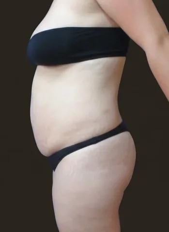 Antes de Lipoescultura + Abdominoplastia + Mastopexia, paciente del Dr. Edgar Achá Vargas