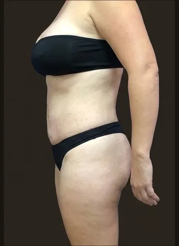 Después de Lipoescultura + Abdominoplastia + Mastopexia, paciente del Dr. Edgar Achá Vargas