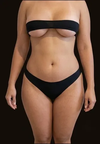 Después de Lipoescultura + Abdominoplastia + Mastopexia, paciente del Dr. Edgar Achá Vargas