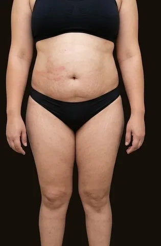 Antes de Lipoescultura + Abdominoplastia, paciente del Dr. Edgar Achá Vargas