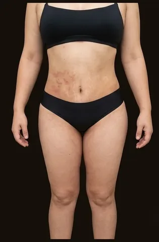 Después de Lipoescultura + Abdominoplastia, paciente del Dr. Edgar Achá Vargas