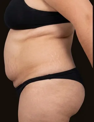 Antes de Lipoescultura + Abdominoplastia, paciente del Dr. Edgar Achá Vargas