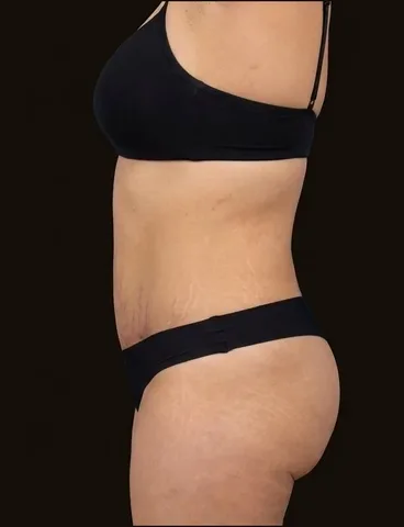 Después de Lipoescultura + Abdominoplastia, paciente del Dr. Edgar Achá Vargas
