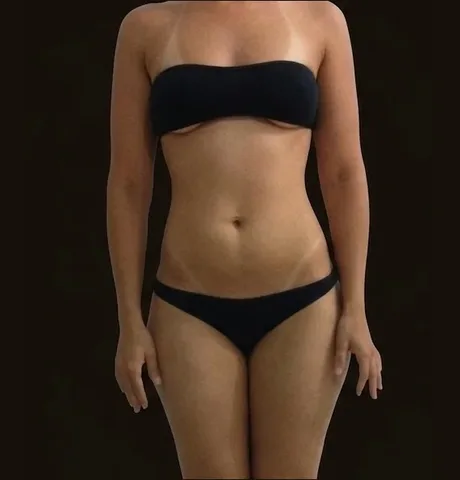 Antes de Lipoescultura + Mamoplastia de Aumento, paciente del Dr. Edgar Achá Vargas