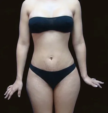 Después de Lipoescultura + Mamoplastia de Aumento, paciente del Dr. Edgar Achá Vargas