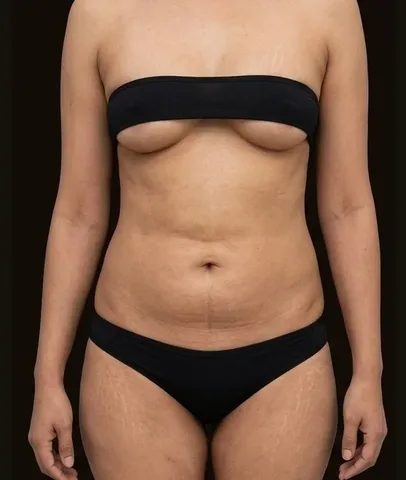 Antes de Lipoescultura + Mamoplastia de Aumento, paciente del Dr. Edgar Achá Vargas