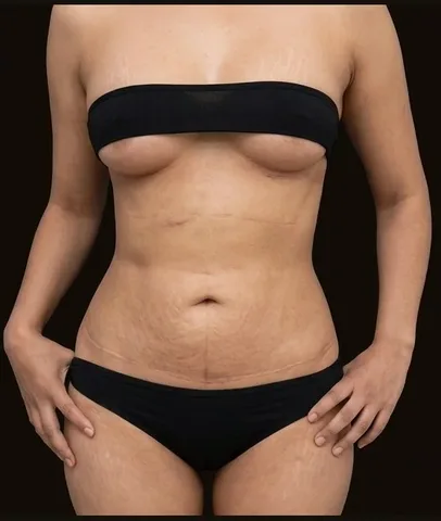 Después de Lipoescultura + Mamoplastia de Aumento, paciente del Dr. Edgar Achá Vargas