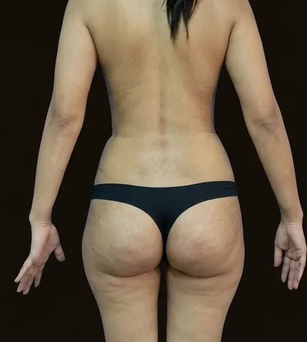 Después de Lipoescultura + Mamoplastia de Aumento, paciente del Dr. Edgar Achá Vargas
