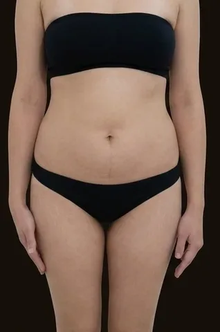 Antes de Lipoescultura + Abdominoplastia, paciente del Dr. Edgar Achá Vargas