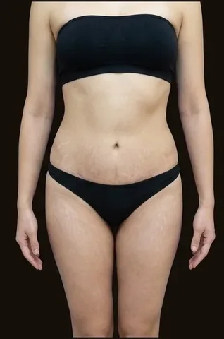 Después de Lipoescultura + Abdominoplastia, paciente del Dr. Edgar Achá Vargas