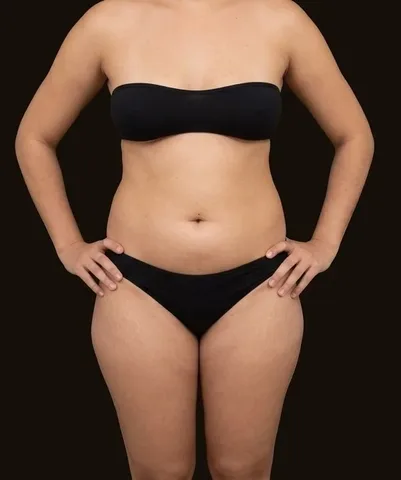 Antes de Lipoescultura + Mamoplastia de Aumento, paciente del Dr. Edgar Achá Vargas