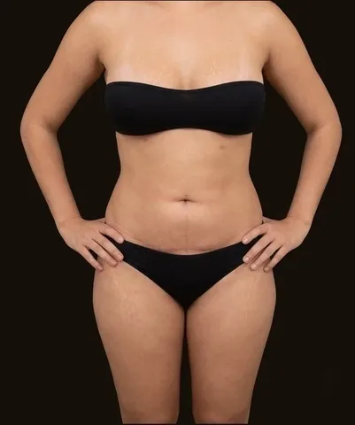 Después de Lipoescultura + Mamoplastia de Aumento, paciente del Dr. Edgar Achá Vargas