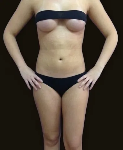 Después de Lipoescultura + Mamoplastia de Aumento, paciente del Dr. Edgar Achá Vargas