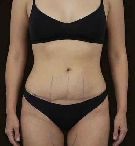 Antes de Lipoescultura + Abdominoplastia, paciente del Dr. Edgar Achá Vargas