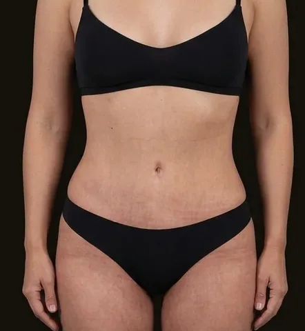 Después de Lipoescultura + Abdominoplastia, paciente del Dr. Edgar Achá Vargas