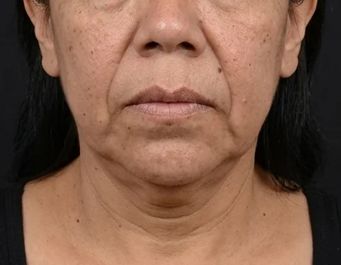 Antes de Lifting Facial, paciente del Dr. Edgar Achá Vargas