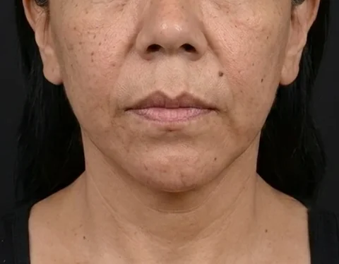 Después de Lifting Facial, paciente del Dr. Edgar Achá Vargas