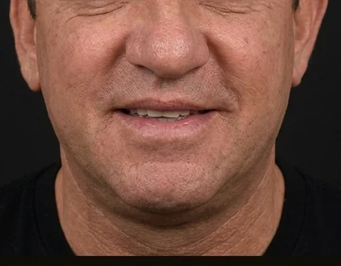 Después de Lifting Facial, paciente del Dr. Edgar Achá Vargas