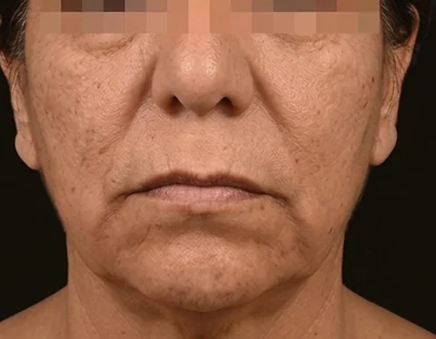 Antes de Lifting Facial, paciente del Dr. Edgar Achá Vargas