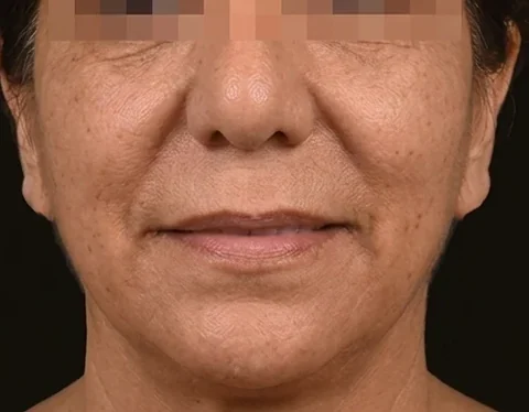 Después de Lifting Facial, paciente del Dr. Edgar Achá Vargas