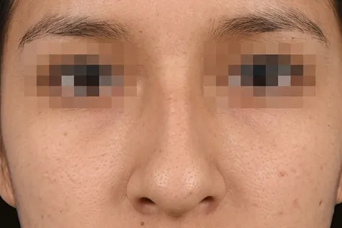 Antes de Rinoplastia, paciente del Dr. Edgar Achá Vargas