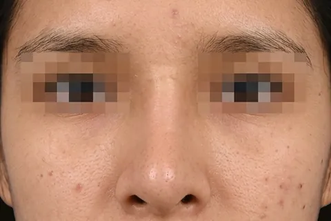 Después de Rinoplastia, paciente del Dr. Edgar Achá Vargas