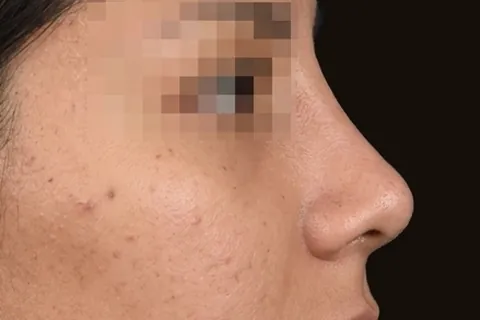 Después de Rinoplastia, paciente del Dr. Edgar Achá Vargas