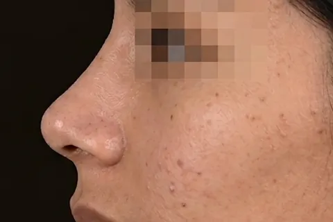Después de Rinoplastia, paciente del Dr. Edgar Achá Vargas