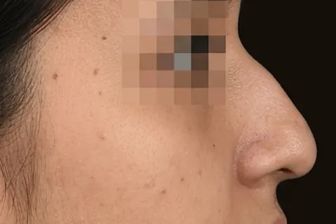 Antes de Rinoplastia, paciente del Dr. Edgar Achá Vargas