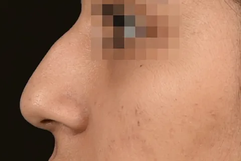 Antes de Rinoplastia, paciente del Dr. Edgar Achá Vargas
