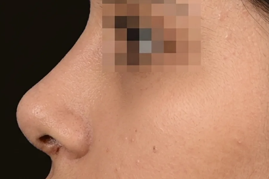 Después de Rinoplastia, paciente del Dr. Edgar Achá Vargas