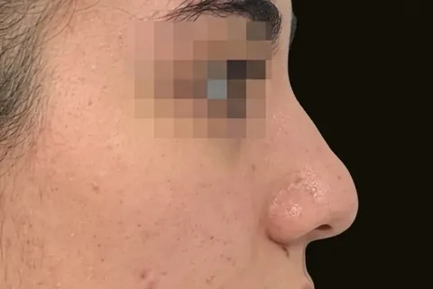 Antes de Rinoplastia, paciente del Dr. Edgar Achá Vargas