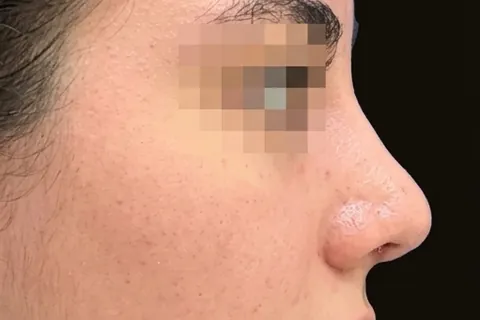 Después de Rinoplastia, paciente del Dr. Edgar Achá Vargas