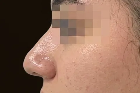 Antes de Rinoplastia, paciente del Dr. Edgar Achá Vargas