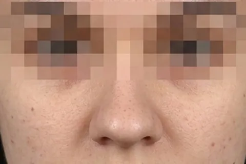 Antes de Rinoplastia, paciente del Dr. Edgar Achá Vargas