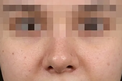 Después de Rinoplastia, paciente del Dr. Edgar Achá Vargas