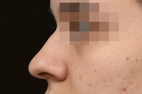 Antes de Rinoplastia, paciente del Dr. Edgar Achá Vargas