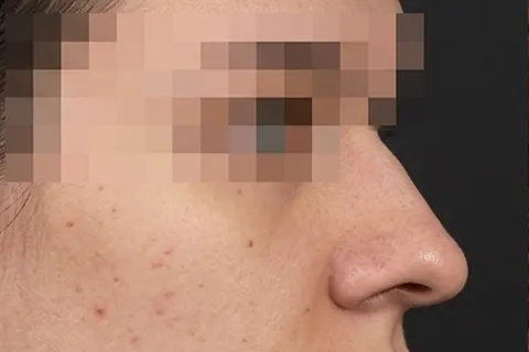 Antes de Rinoplastia, paciente del Dr. Edgar Achá Vargas