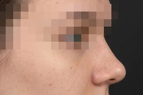 Después de Rinoplastia, paciente del Dr. Edgar Achá Vargas