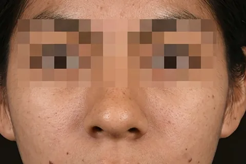 Antes de Rinoplastia, paciente del Dr. Edgar Achá Vargas