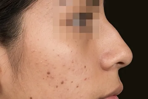 Antes de Rinoplastia, paciente del Dr. Edgar Achá Vargas