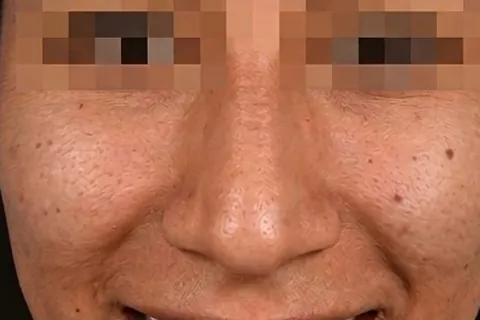 Antes de Rinoplastia, paciente del Dr. Edgar Achá Vargas